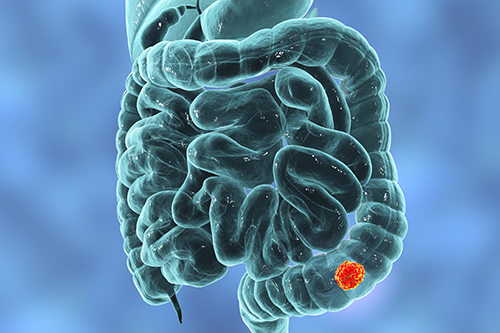 3D illustration of a human small intestine and colon, colored in teal. Near the rectum, there is a mass (about half the diameter of the colon) colored in red and orange that represents a tumor.
