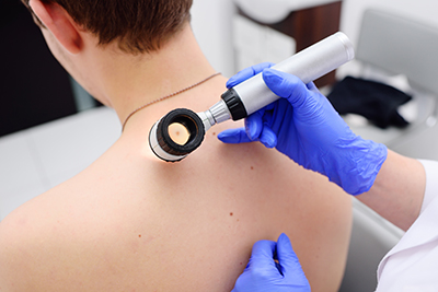 physician’s gloved hands hold a dermatoscope to a person’s bare back.