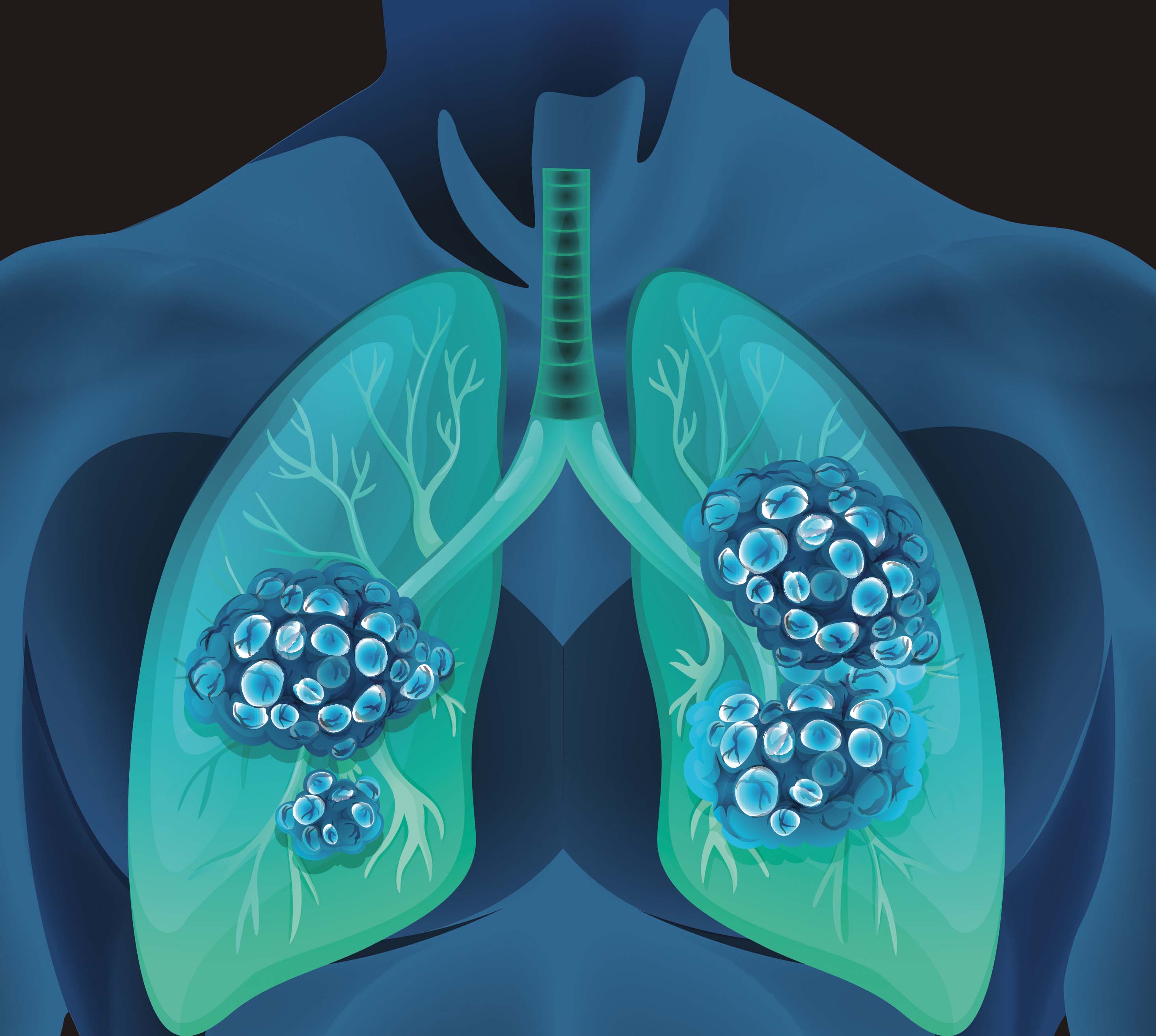 Can Chemo Cure Small Cell Lung Cancer