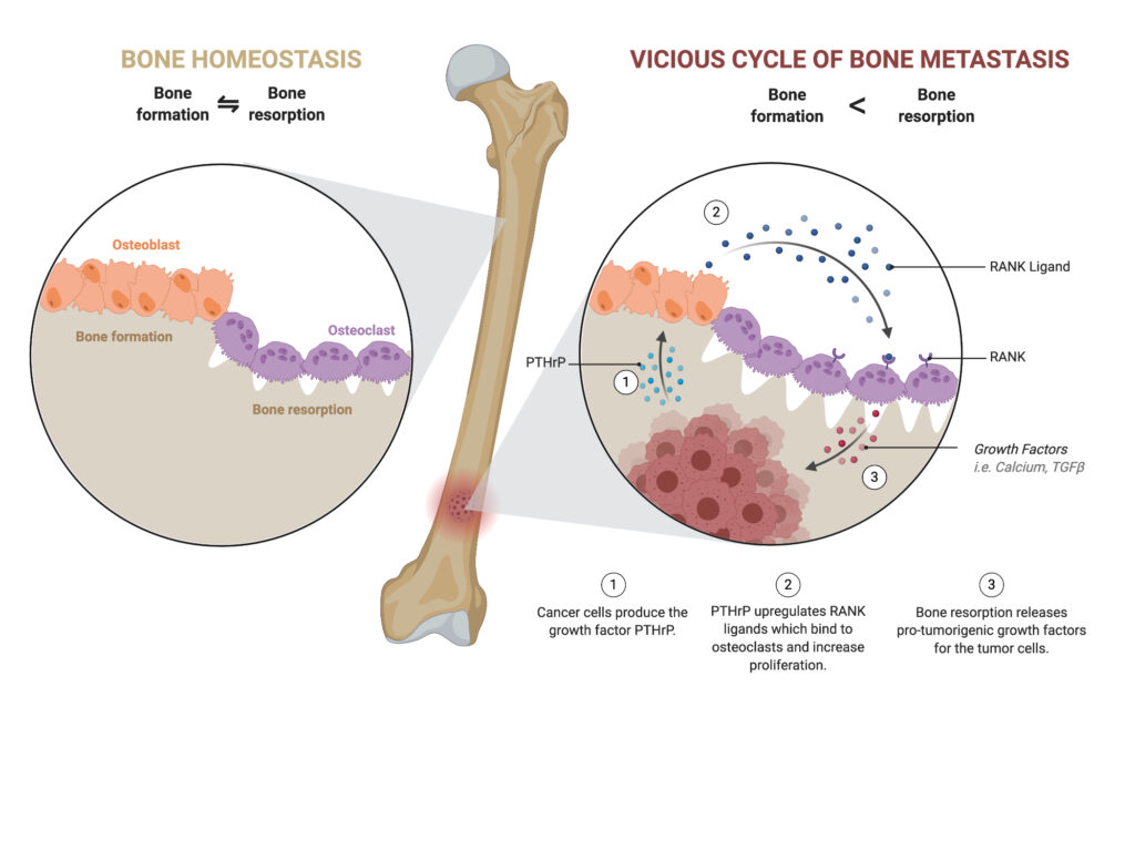 Breast cancer metastasis to the bone microenvironment young scientist